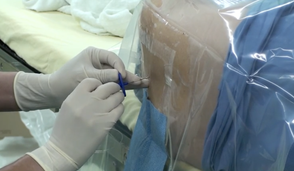 【現役医師が解説】無痛分娩の麻酔の手順を画像付きで解説！